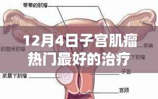 12月4日最新热门子宫肌瘤治疗方法全面评测及最佳疗法探讨