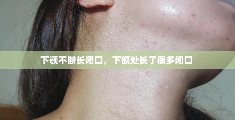 下颚不断长闭口,下颌处长了很多闭口