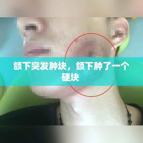 颌下突发肿块,颌下肿了一个硬块