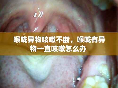 喉咙异物咳嗽不断,喉咙有异物一直咳嗽怎么办